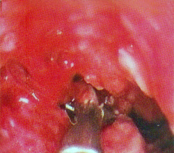 Ca Esophagus - Biopsy