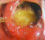 Duodenal Ulcer