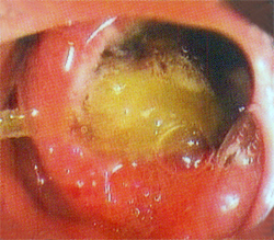 Duodenal Ulcer