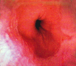 Hiatus Hernia